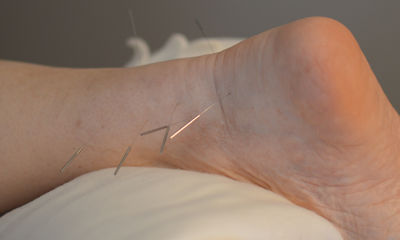 Acupuncture